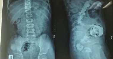 فريق جراحى ببنها للتأمين الصحى ينجح فى استئصال المستقيم وجزء من القولون لطفل